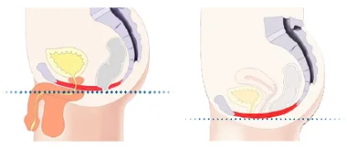 Urinary Incontinence